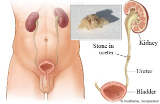 cara menghancurkan batu ginjal tanpa operasi,obat batu ginjal,obat kencing batu,cara mengeluarkan batu ginjal tanpa operasi,cara menghilangkan batu ginjal tanpa operasi