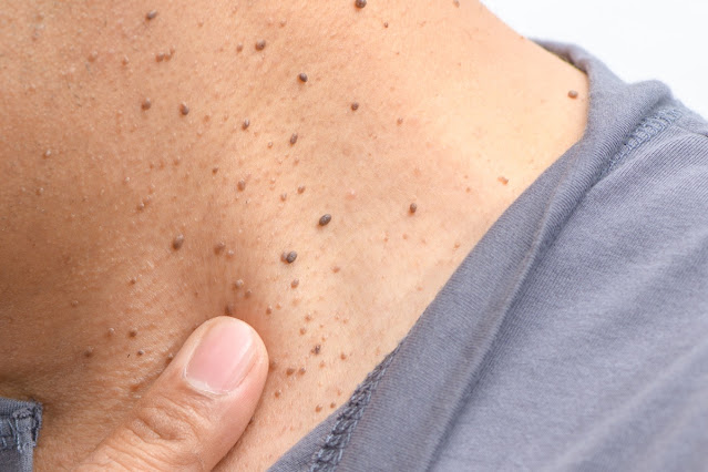 Multiple small skin tags can be removed with cryotherapy