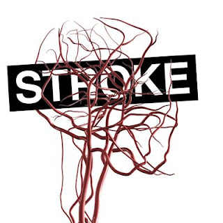 Mengobati penyakit stroke yang paling efisien, Obat Stroke Susah Bicara, Cara Mengobati Stroke Akibat Diabetes, Mengobati Penyakit Stroke Yang Paling Efisien, Bagaimana Mengobati Stroke Ringan, Obat Alternatif Stroke Ringan, Contoh Penyakit Stroke, Obat Stroke Com, Obat Stroke Menurut Ustad Danu, Pengobatan Stroke Bogor, Cara Terapi Penyakit Stroke Ringan, Cara Pengobatan Stroke Secara Medis