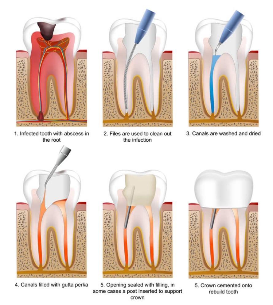 Cerita Yna: Pengalaman Buat Root Canal Treatment (RCT)