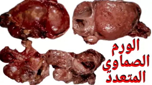 تكون الورم الصماوي المتعدد Multiple endocrine neoplasia تكون الورم الصماوي المتعدد Multiple endocrine neoplasia