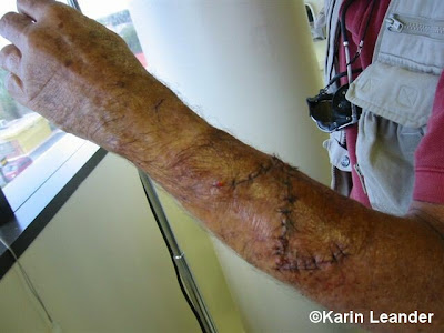 a skin rash Spider bite on spider bite symptoms swelling. a skin rash Spider bite on