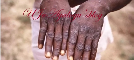 BREAKING: Outbreak of monkeypox hits Bayelsa, 10 persons quarantined 