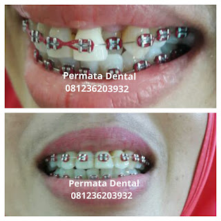 gambar foto behel bracket kawat gigi sebelum dan sesudah perawatan untuk memperbaiki merapikan gigi gingsul gigi miring renggang tonggos berantakan keluar masuk jarang diastema maju mundur tidak rapi tidak beraturan bali denpasar banyuwangi jember tidak rata kocar kacir