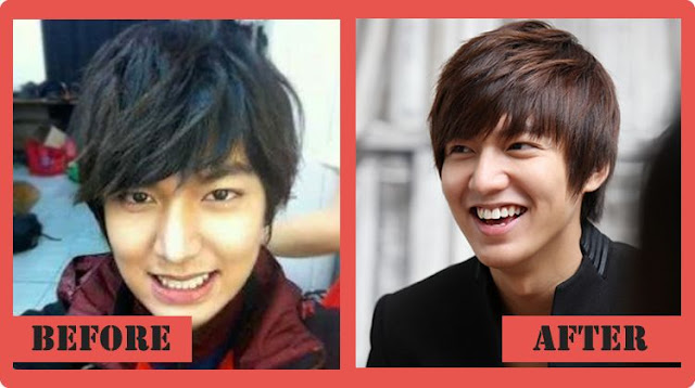 Lee Min Ho Before and After Plastic Surgery 