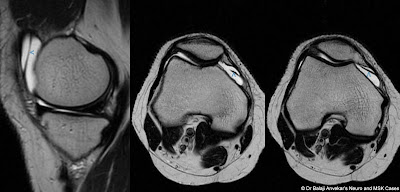 medial%2Bplica%2Bsyndrome.jpg