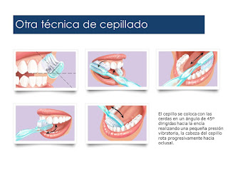 Resultado de imagen para Técnica de Stillman Modificada: