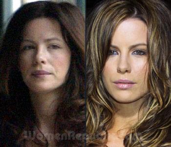 Kate Beckinsale Plastic Surgery Before And After: 02/16/12