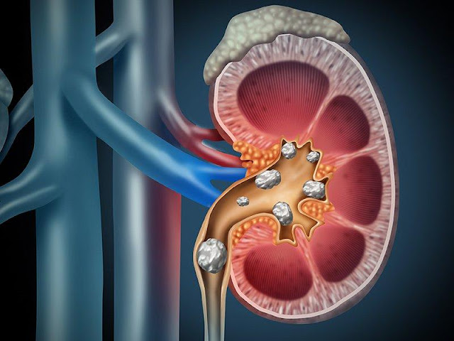 Urolithiasis Management Devices Market