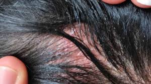 Hair Dye Allergy