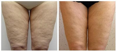 Mesotherapy Photos