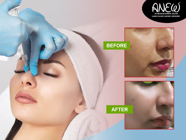 Non Surgical Rhinoplasty in Bangalore