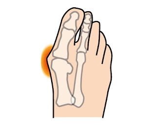 外反母趾になり、足の親指（母趾）の付け根の突出部が靴に当たって摩擦痛を起こしている状態をあらわしたイラスト