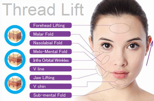 Thread Lift (Tanam Benang)