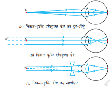 Near sightedness in hindi