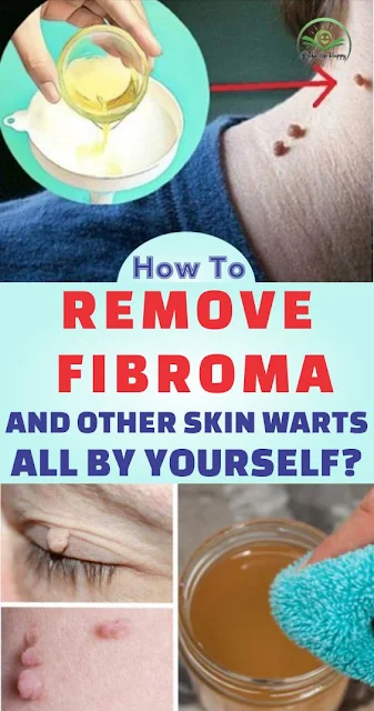 Natural Skin Warts Or Fibroma Removal Right From Your Kitchen