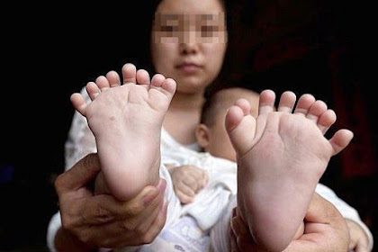 Bayi Ini Punya 31 Jari, Rupanya Ibunya Lakukan Ini Sewaktu Hamil