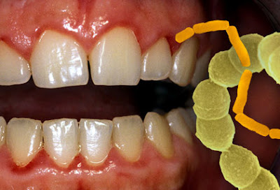 Tiêu diệt vi khuẩn gây bệnh răng miệng tại nha khoa-1