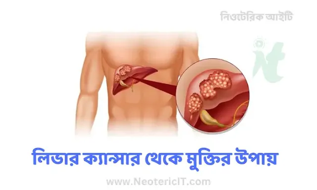 লিভার ক্যান্সার থেকে মুক্তির উপায় - liver cancer - NeotericIT.com