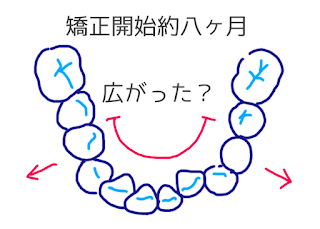 ©さんがつの歯科矯正を始めます　歯のイラスト