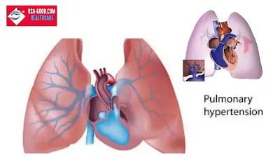 What Is Pulmonary Hypertension (PH)?