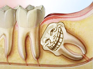 Ảnh hưởng của răng khôn tới sức khỏe răng miệng