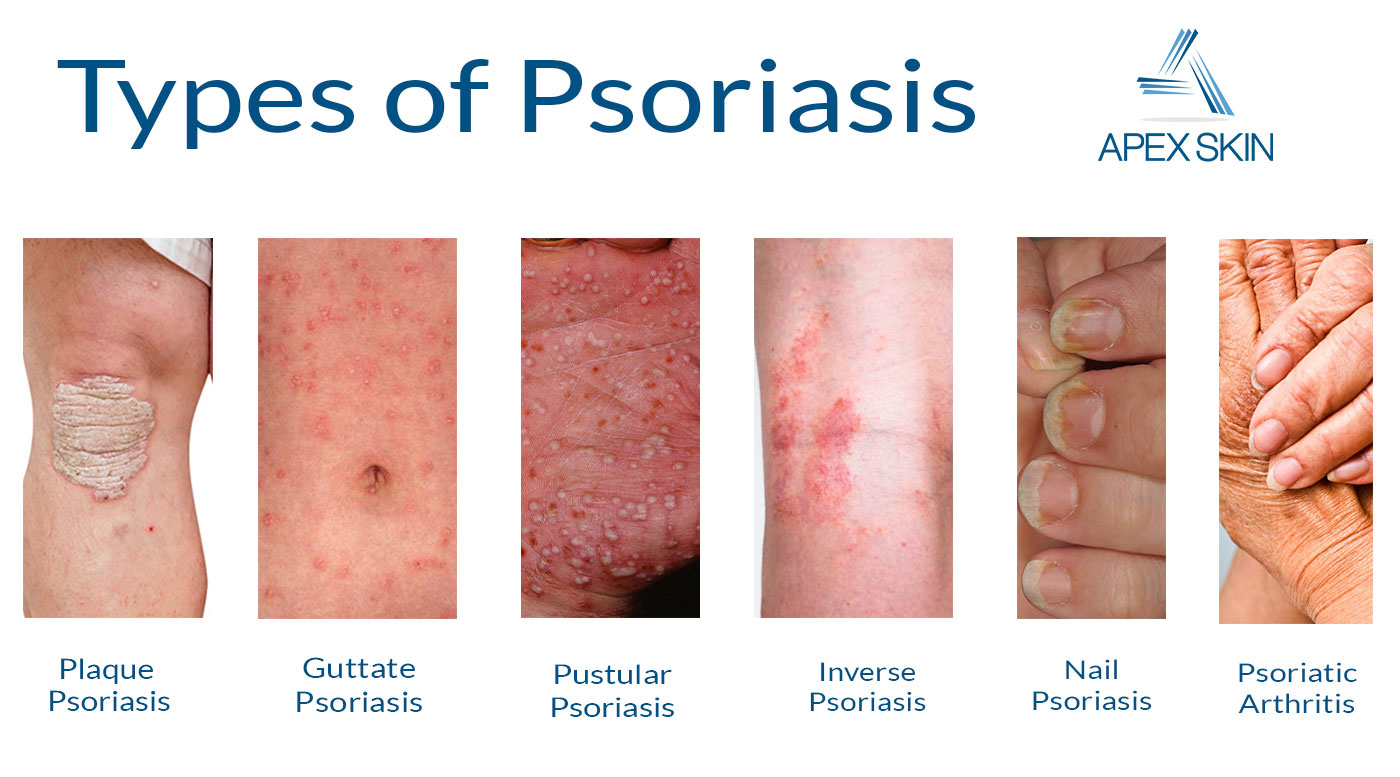 psoriasis | psoriasis symptoms Types and Management