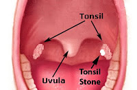 Lingual Tonsil Removal Side Effects