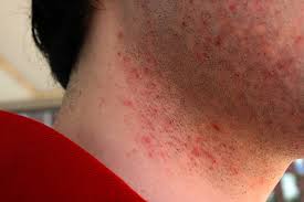 The Best Ways to Prevent Razor Burn
