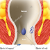 Bệnh trĩ, tìm hiểu về bệnh trĩ tái phát!