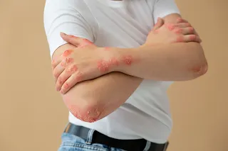 Man suffering from Dermatitis