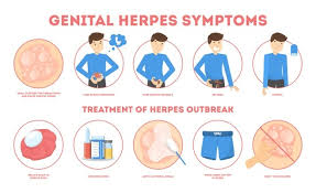 Herpes' test constraints in Kastina State