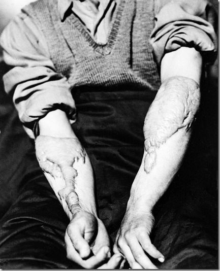 HIROSHIMA WOUNDED