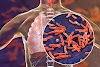 Perjuangan Melawan TBC: Mengejar Impian Indonesia Bebas Penyakit Tuberkulosis