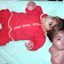 Egyptian Girl With 2 Two Heads and One Body- Unbelievably tragic!
