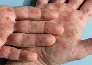 Paraíba já contabiliza 76 casos confirmados de varíola dos macacos