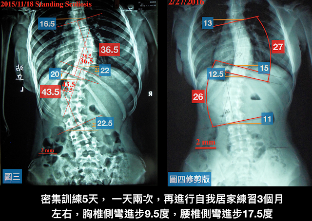 脊椎側彎, 脊椎側彎背架, 脊椎度數,脊椎側彎矯正, 脊椎側彎治療, 脊椎側彎矯正成功案例, 脊椎側彎 復健