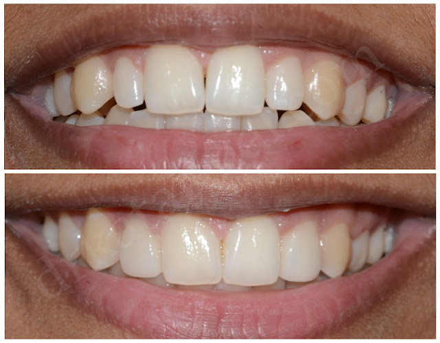 Porcelain Veneers for Peg (Small) Lateral Incisors