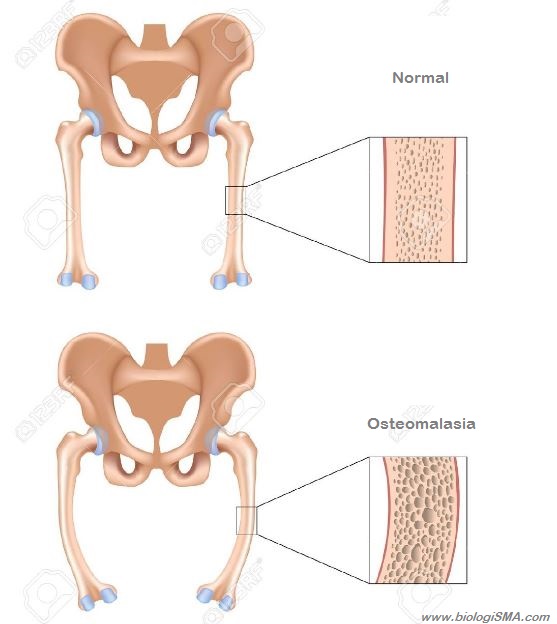 osteomalasia