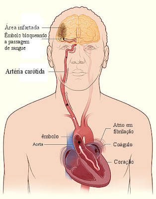 AVC - Fibrilação atrial e embolia cerebral