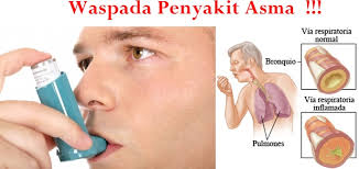 Obat asma  herbal paling ampuh Obat Paru Paru