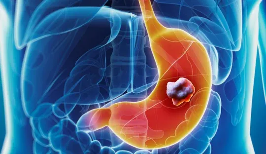 Barriga Inchada pode ser Sinal de Câncer?