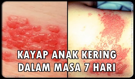 KAYAP PADA ANAK KERING DALAM MASA 7 HARI!