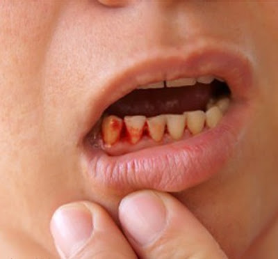 Nguyên nhân bị viêm chân răng bạn cần đề phòng-2