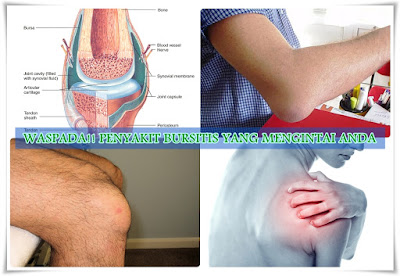 Pengobatan Alami Bursitis Secara Tradisional Yang Cepat