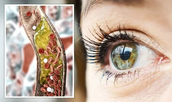 Higher Cholesterol: Indications that Indicator your Problem has actually end up being Sight-threatening