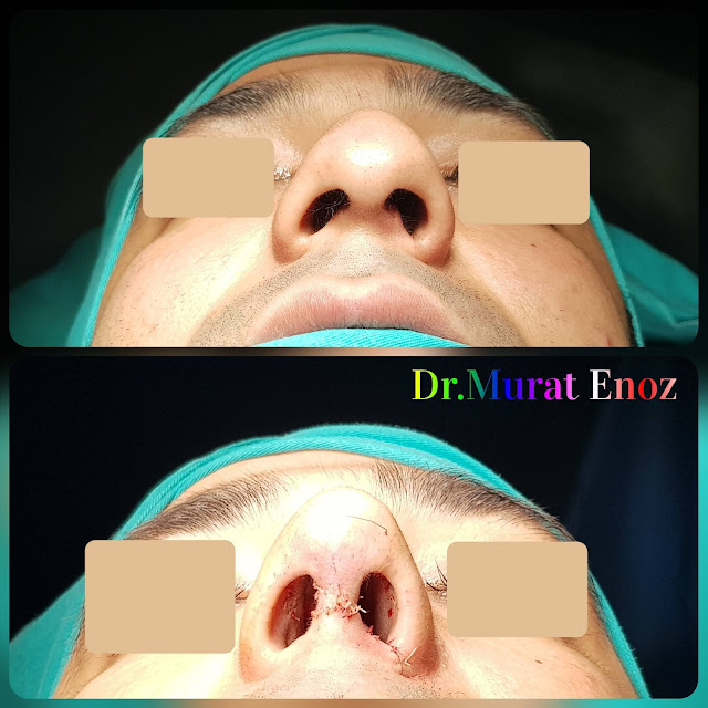 Thick Skinned Male Rhinoplasty Turkey, Nose Job For Men Istanbul, Droopy Nose Aesthetic For Men