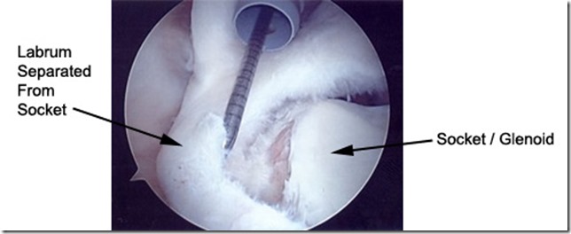 labral1