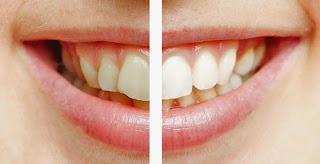 the cosmetic dental center of huntsville teeth whitening