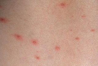 chicken pox pictures Red rash spots appear on the skin